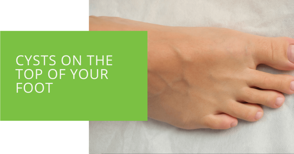 Cysts on the Top of Your Foot