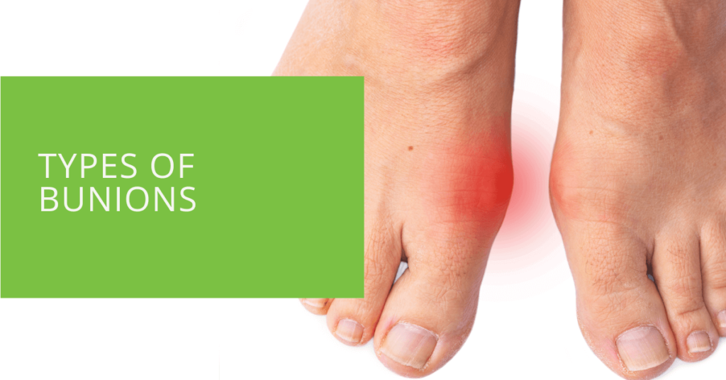 Types of Bunions