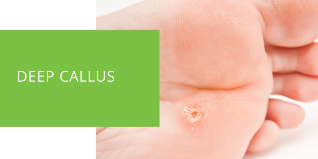 Deep Callus