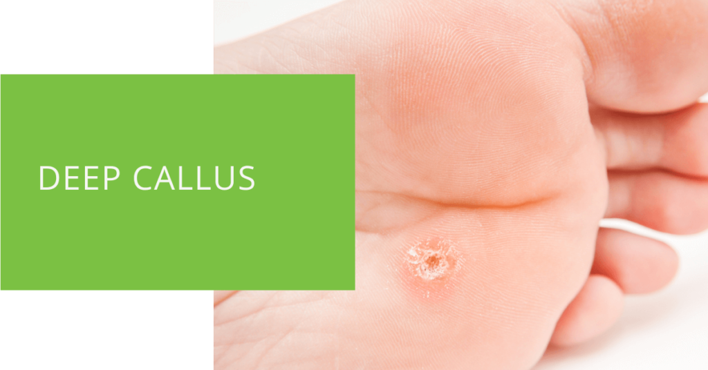 Deep Callus