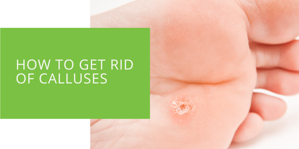 How to Get Rid of Calluses