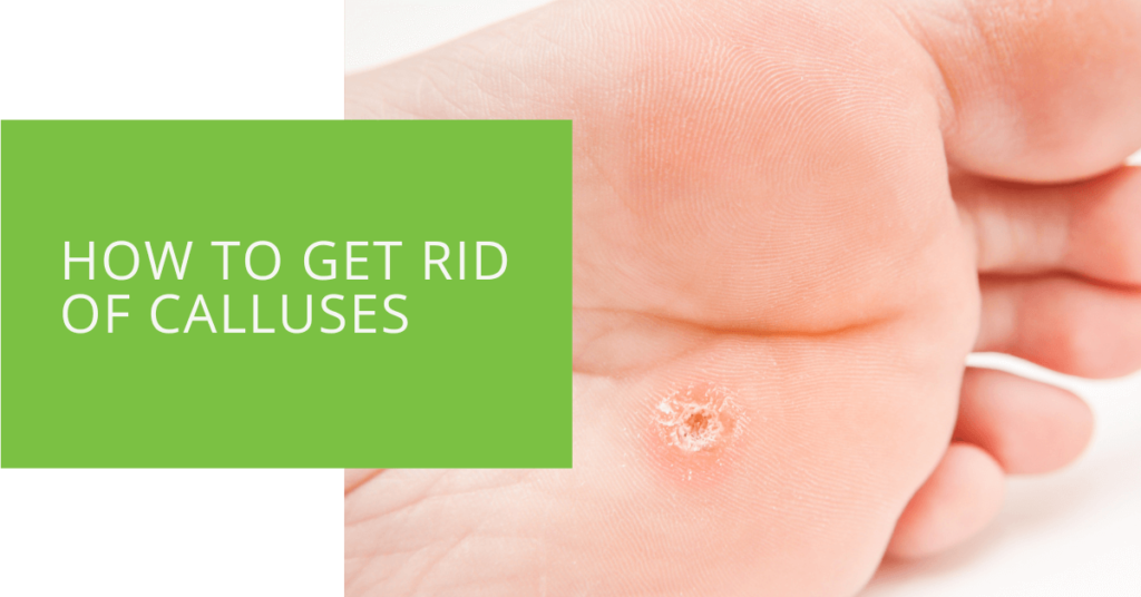 How to Get Rid of Calluses