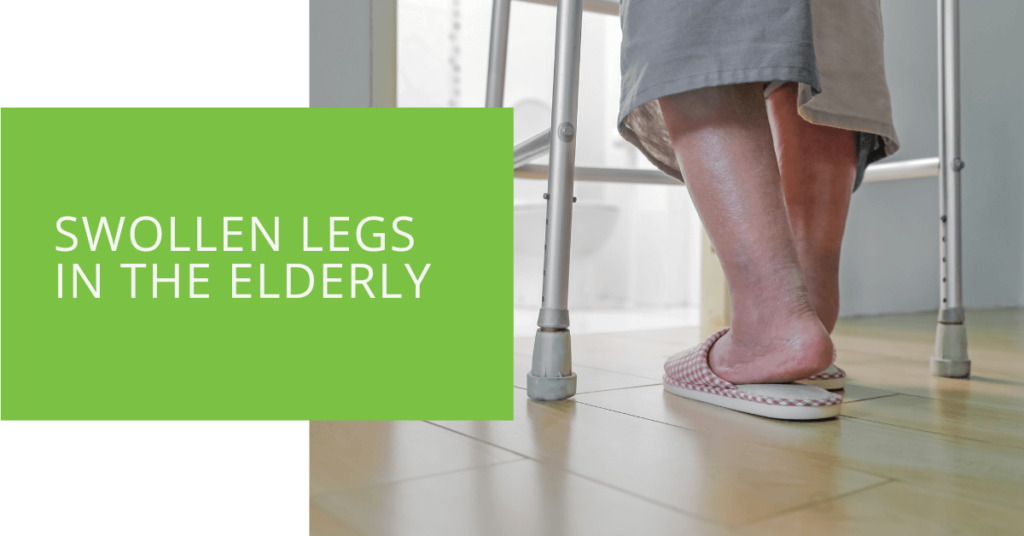 Swollen Legs in the Elderly