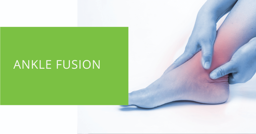 Ankle Fusion