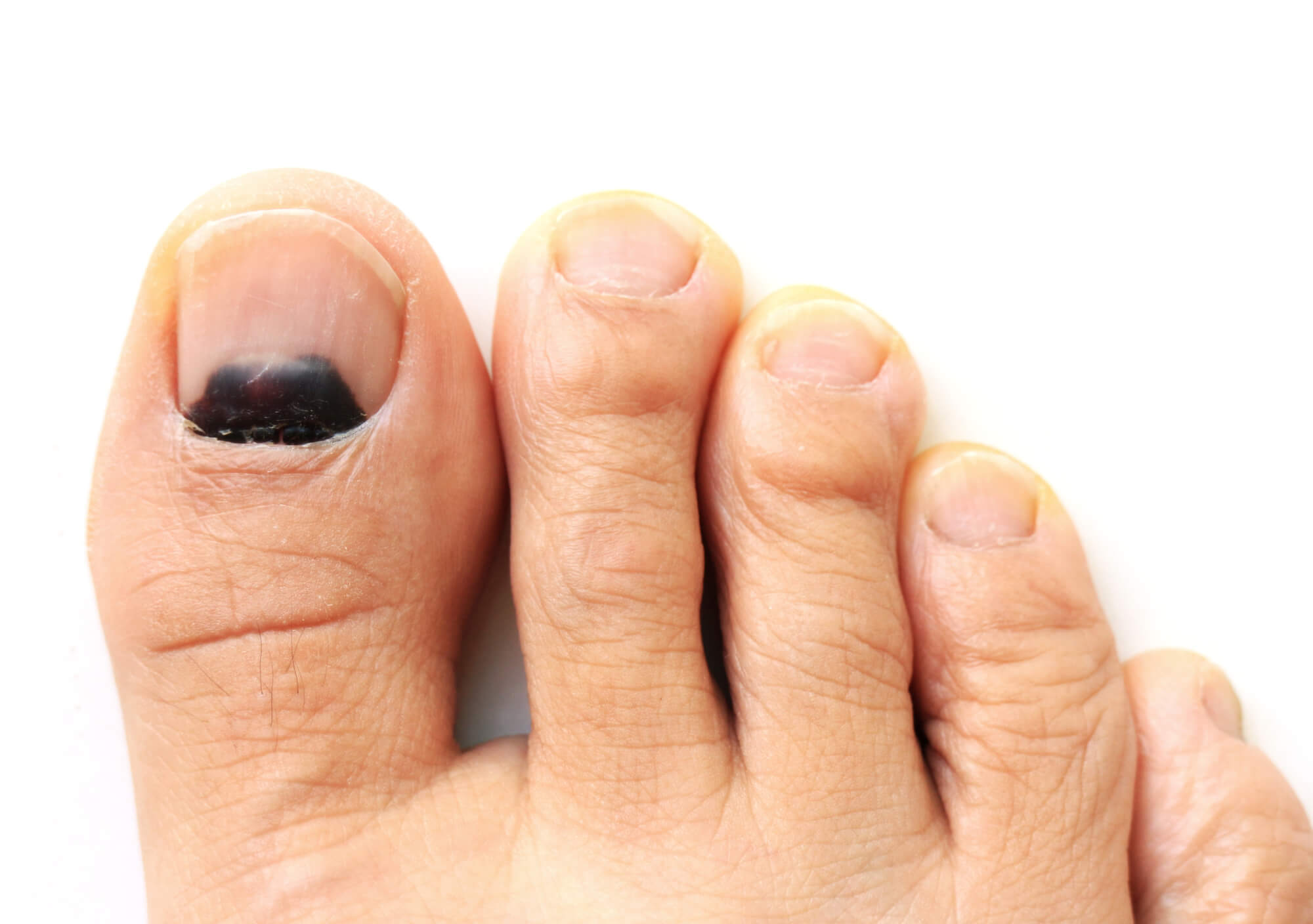 Black spot under toenail