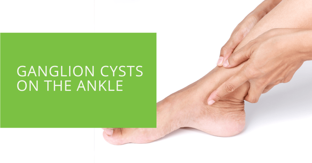 Ganglion Cysts on the Ankle