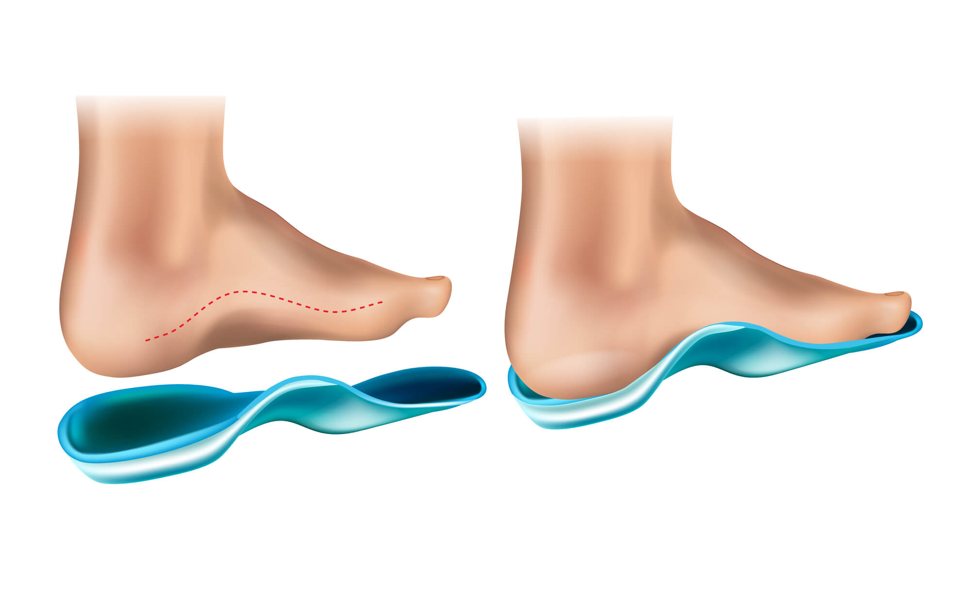 Orthotic Arch Support