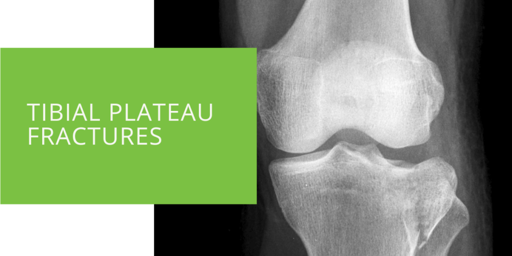 Tibial Plateau Fractures