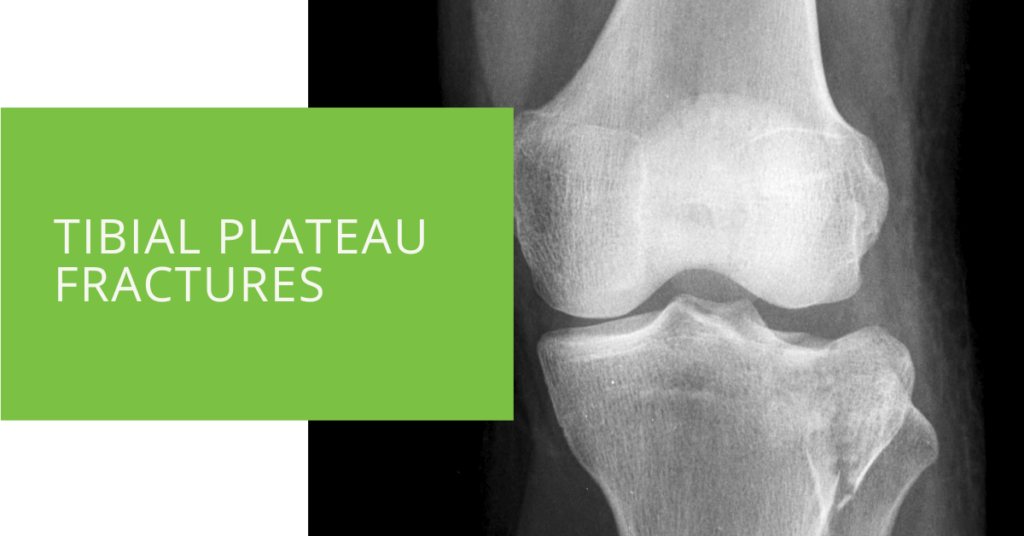 Tibial Plateau Fractures