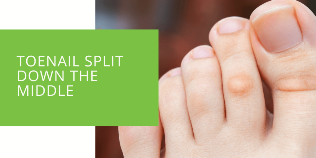 Toenail Split Down the Middle